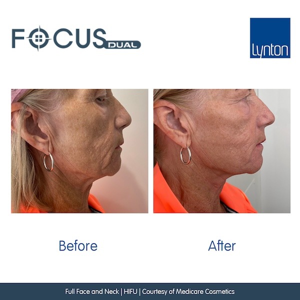 Before-and-After.-Focus-Dual.-Full-Face-and-Neck.-HIFU.-Medicare-Cosmetics Fountain of Youth Salisbury