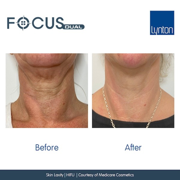 RF microneedling salisbury