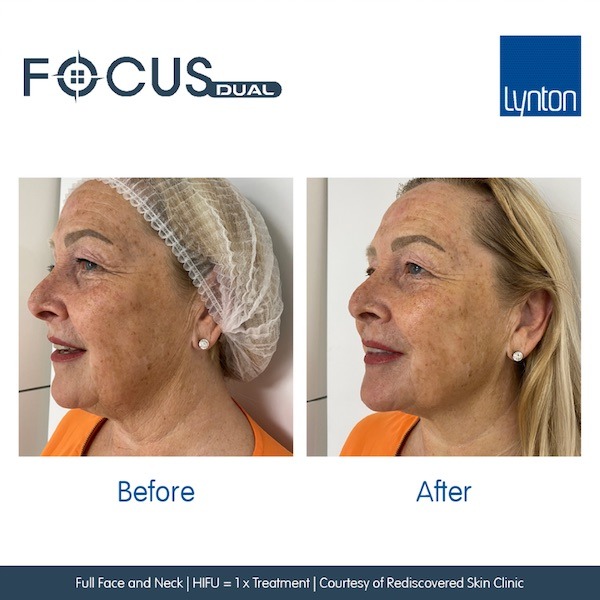 Before-and-After.-Focus-Dual.-Skin-Laxity.-HIFU.-Rediscovered-Skin-Clinic Fountain of Youth Salisbury