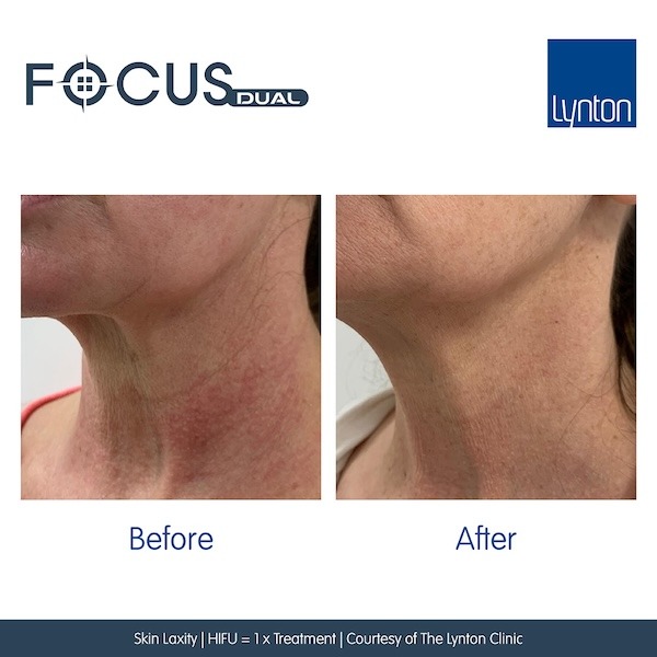 Before-and-After.-Focus-Dual.-Skin-Laxity.-HIFU.-The-Lynton-Clinic - Fountain of Youth Salisbury
