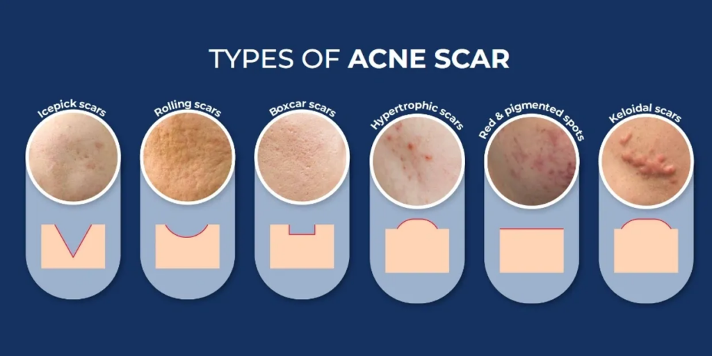 Types of acne scar

